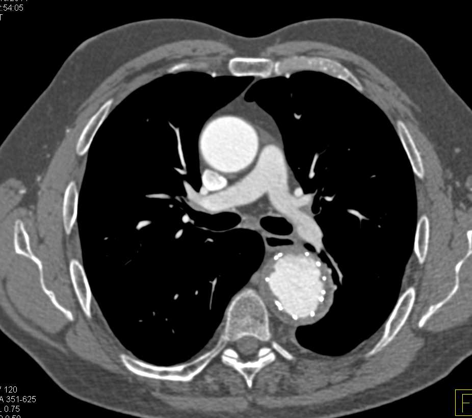 Endovascular Stent in the Descending Thoracic Aorta - CTisus CT Scan