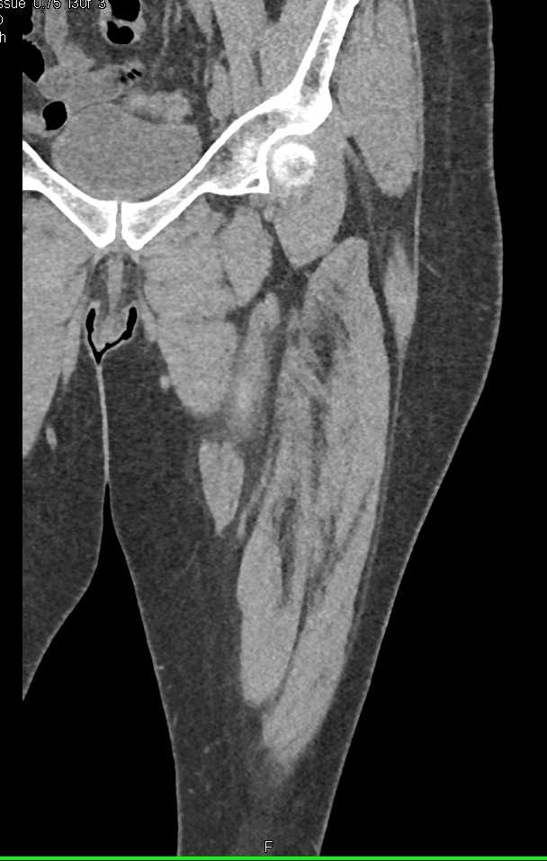 Dissection and Occlusion of the Left Superficial Femoral Artery (SFA) on MIP DE - CTisus CT Scan