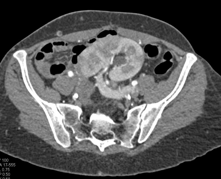 Extensive Vascular Calcifications in End Stage Renal Disease (ESRD) Patient - CTisus CT Scan