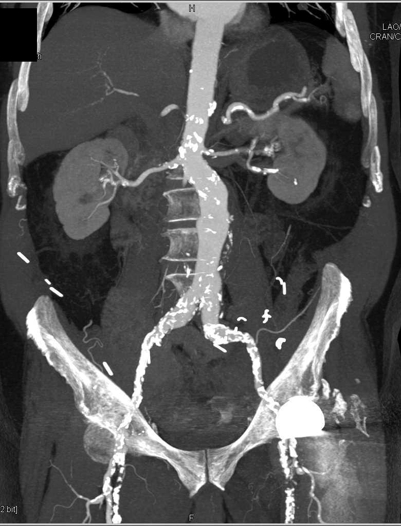 Occluded Left Femoral Artery - CTisus CT Scan