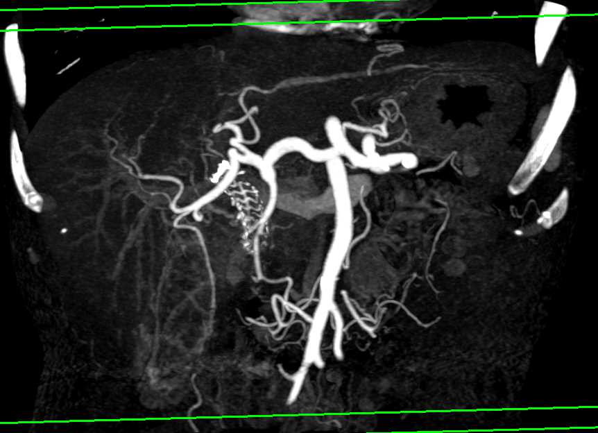 Stent in Common Bile Duct with Patent Arterial Map - CTisus CT Scan