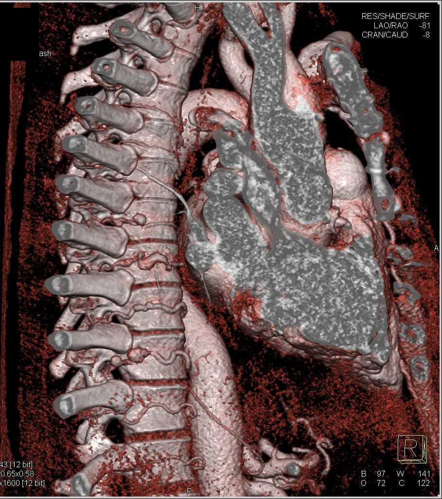 Dilated Intercostal Arteries with Aneurysms in Ehlers-Danlos Patient. Superior Mesenteric Artery (SMA) Aneurysm also seen - CTisus CT Scan