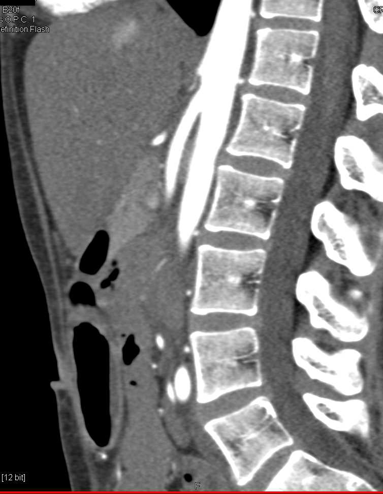 Superior Mesenteric Artery (SMA) Syndrome with Narrowed SMA Angle - CTisus CT Scan