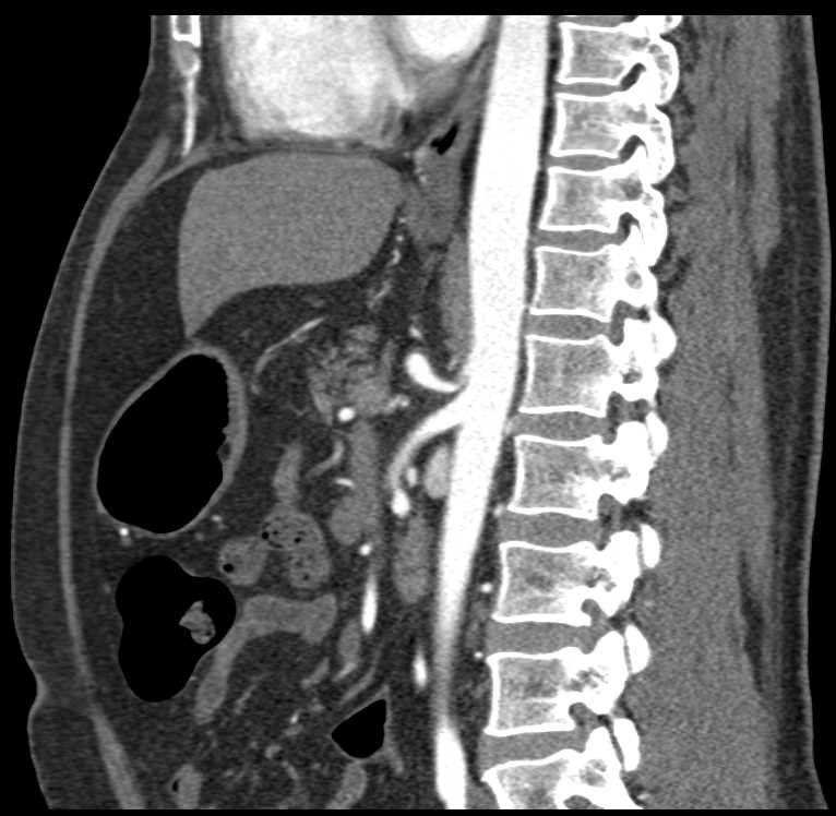 Compression Celiac Artery by Median Arcuate Ligament - CTisus CT Scan