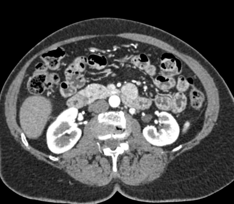 Aneurysm of a Branch of the Superior Mesenteric Vein (SMV) - CTisus CT Scan