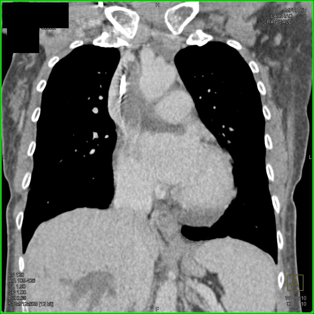 Thrombus in Superior Vena Cava (SVC), Inferior Vena Cava (IVC) and Portal Vein - CTisus CT Scan