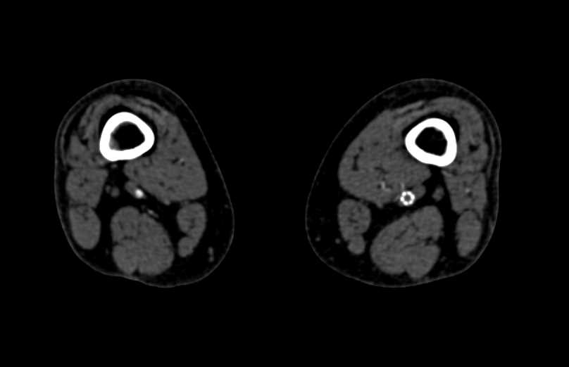 CTA with Occluded Left Vascular Stent - CTisus CT Scan