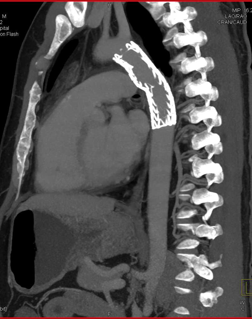 Endovascular Repair of Traumatic Dissection of Thoracic Aorta - CTisus CT Scan