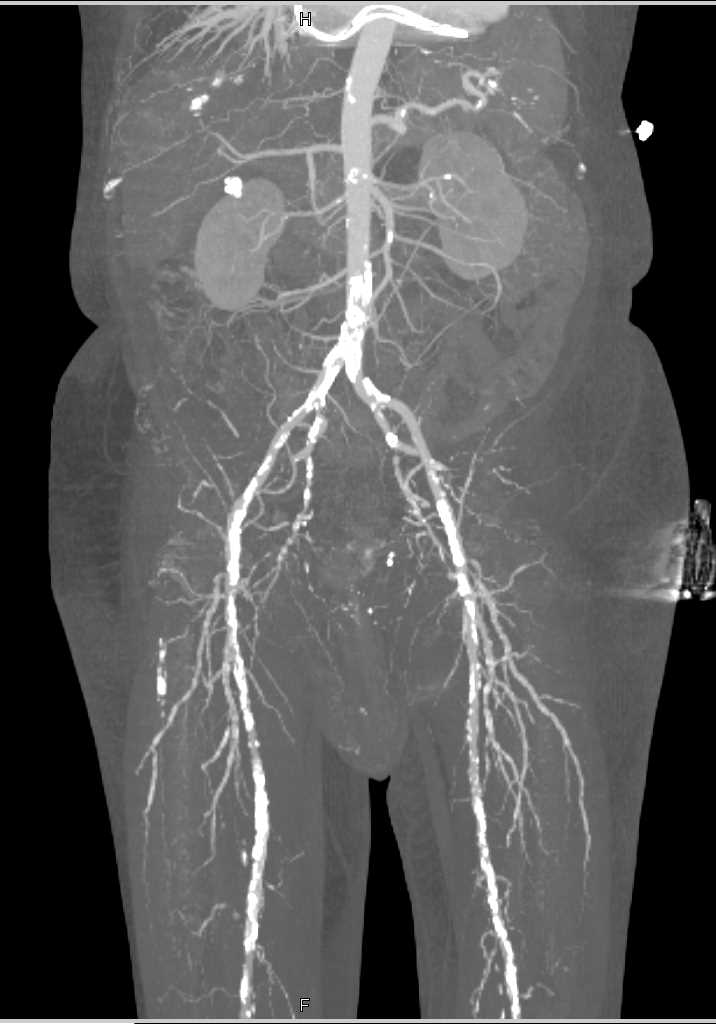 CTA Runoff with Peripheral Vascular Disease - CTisus CT Scan