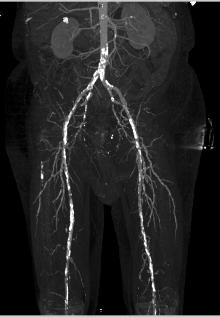 CTA Runoff with Peripheral Vascular Disease - CTisus CT Scan