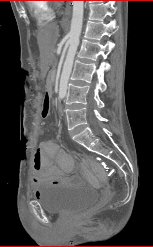 Superior Mesenteric Artery (SMA) Angle Narrowed - CTisus CT Scan