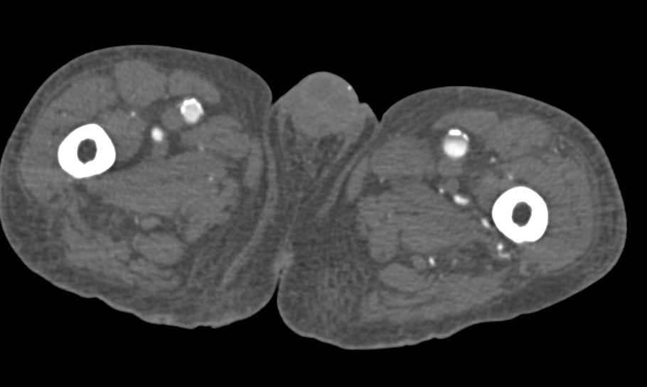 CTA Runoff with Extensive Peripheral Vascular Disease - CTisus CT Scan