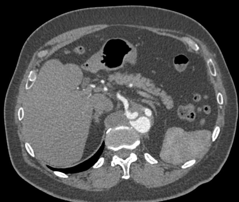 Aortic Dissection - CTisus CT Scan