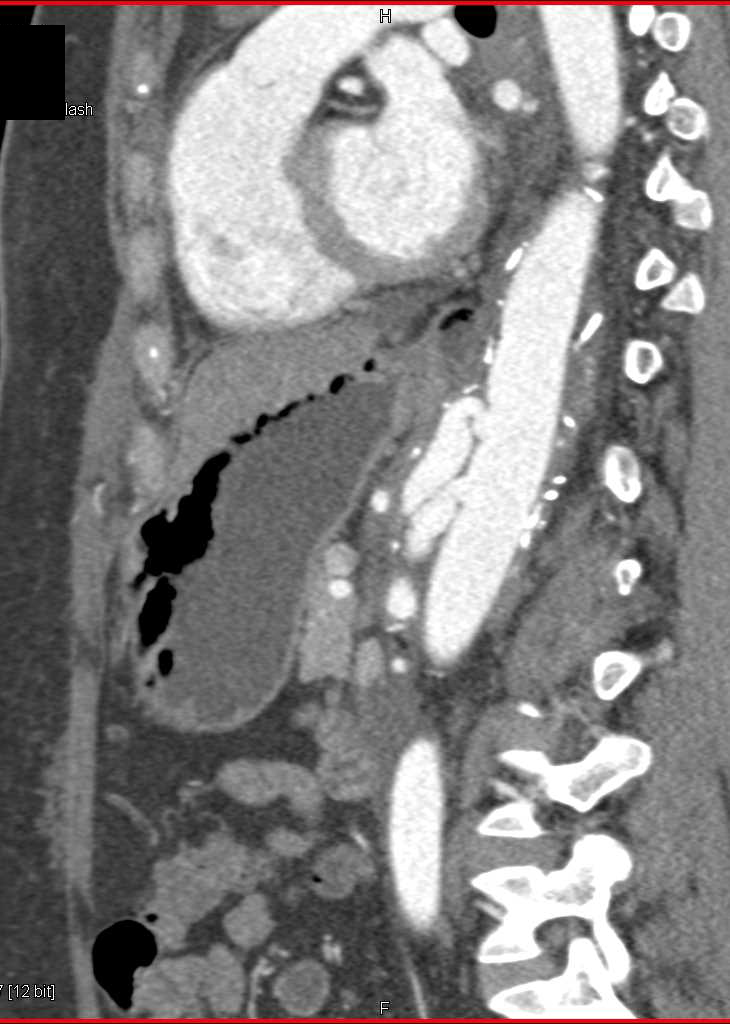 Aneurysmal Dilatation of the Celiac Artery with Dissection - CTisus CT Scan