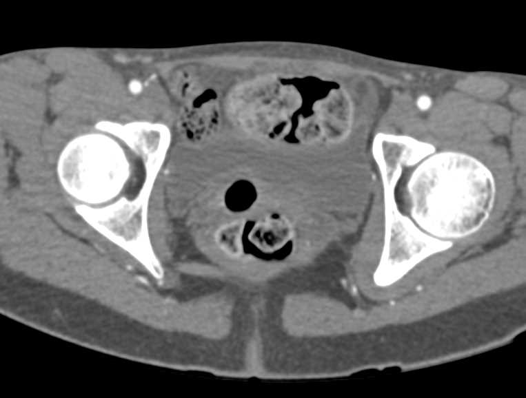 CTA Runoff with Normal Vascular Map - CTisus CT Scan