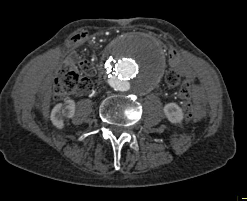 Type 2 Endoleak - CTisus CT Scan