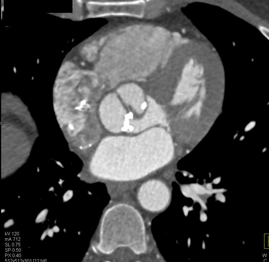 Aortic Valvular Calcification with Aortic Stenosis and Dilated Ascending Aorta - CTisus CT Scan