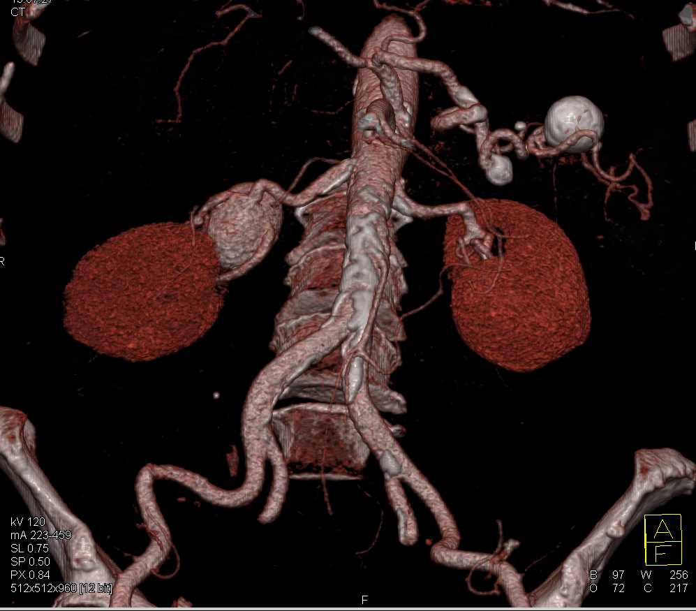 Right Renal Artery and Splenic Artery Aneurysms - CTisus CT Scan