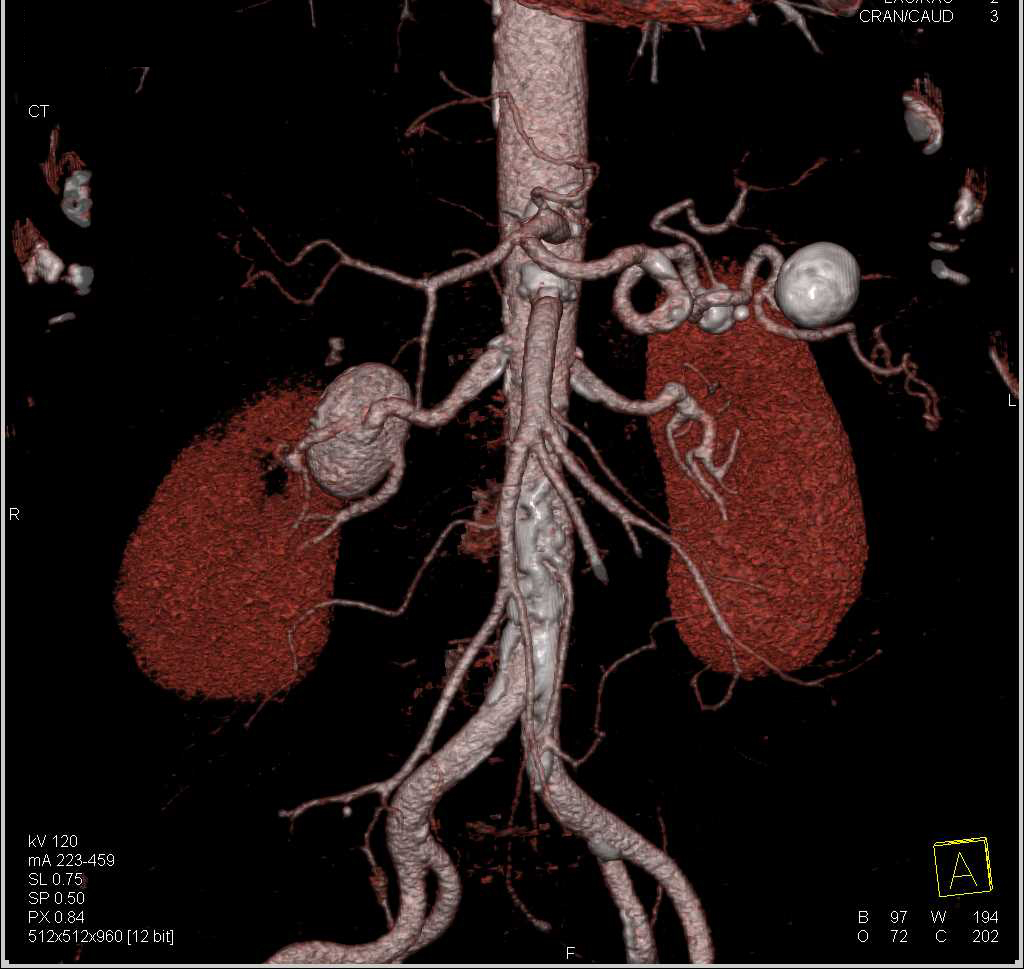 Right Renal Artery and Splenic Artery Aneurysms - CTisus CT Scan