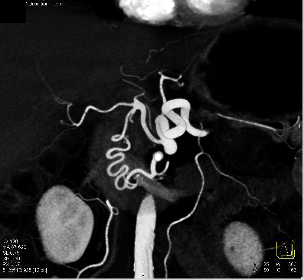 Occlusion Celiac Axis with Collateral Pathways Including Prominent Gastroduodenal Artery (GDA) - CTisus CT Scan