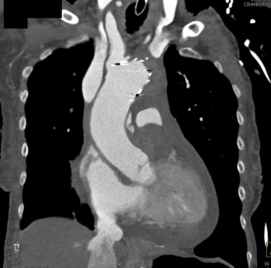 Type A Dissection with Mediastinal Bleed and Stent in Descending Aorta - CTisus CT Scan