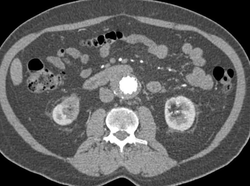 Infarct Right Kidney s/p Endovascular Stent Placement - CTisus CT Scan