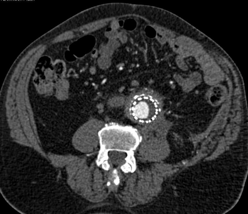 Occluded Left Iliac Artery with Fem-Fem Bypass - CTisus CT Scan