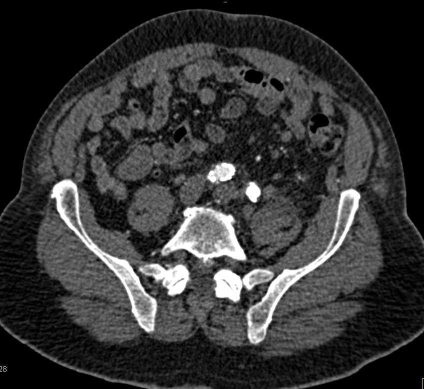 Fem-Fem Bypass Graft with Peripheral Vascular Disease - CTisus CT Scan