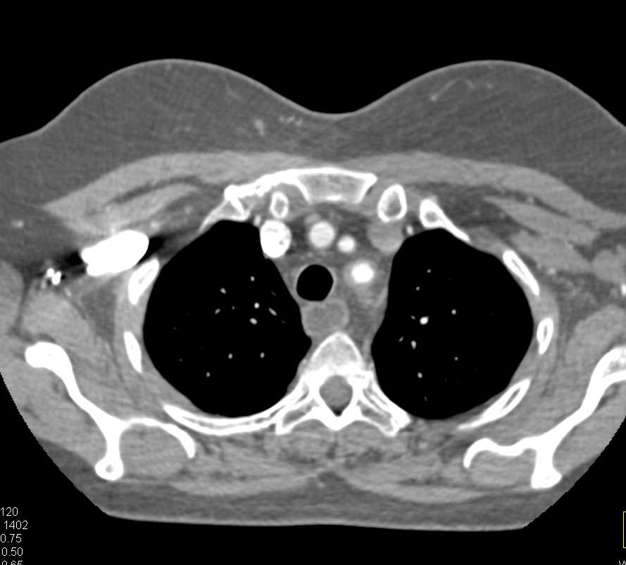 Takayasu's Arteritis Involves the Left Subclavian Artery - CTisus CT Scan