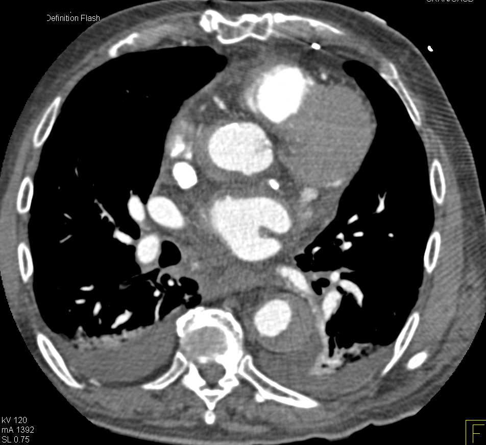 Aortic Dissection with Intramural Hematoma - Vascular Case Studies ...