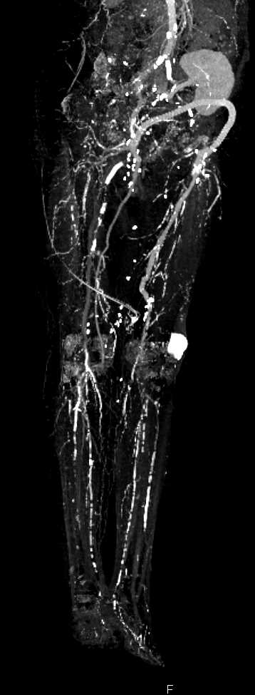 Fem-Fem Bypass Graft with Extensive Peripheral Vascular Disease - CTisus CT Scan