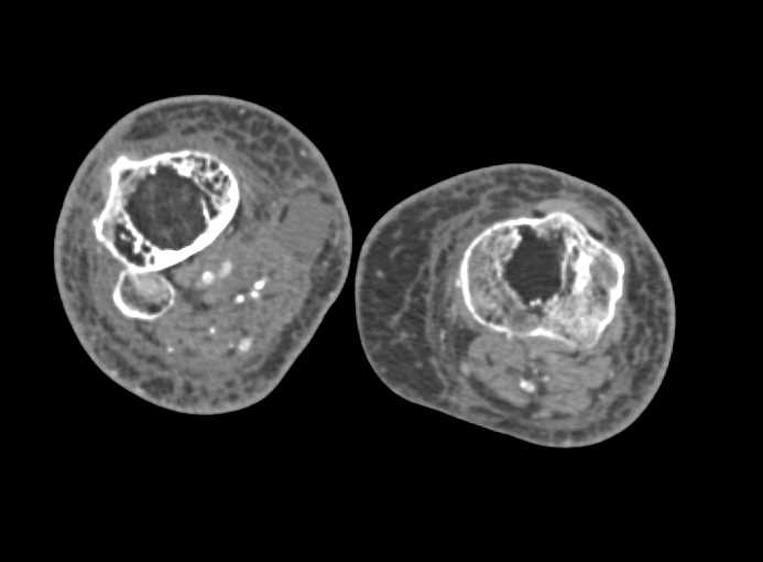 Fem-Fem Bypass Graft with Extensive Peripheral Vascular Disease - CTisus CT Scan