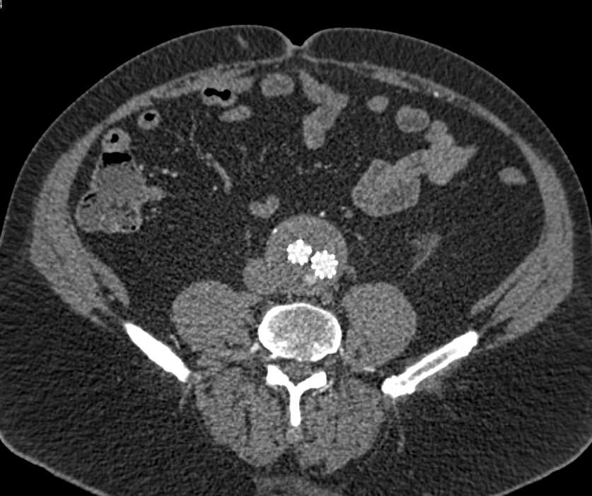 Type II Endoleak - CTisus CT Scan