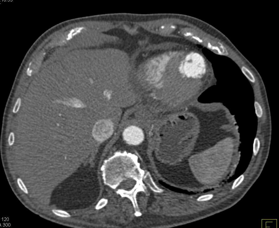 Normal Vascular GI Map - CTisus CT Scan