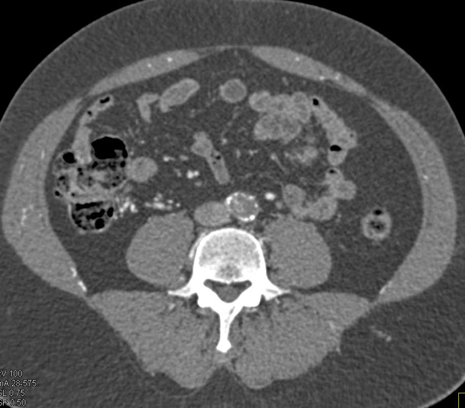 Aortic Occlusion due to Atherosclerotic Disease - CTisus CT Scan