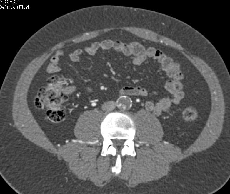 Aortic Occlusion due to Atherosclerotic Disease with Collaterals - CTisus CT Scan