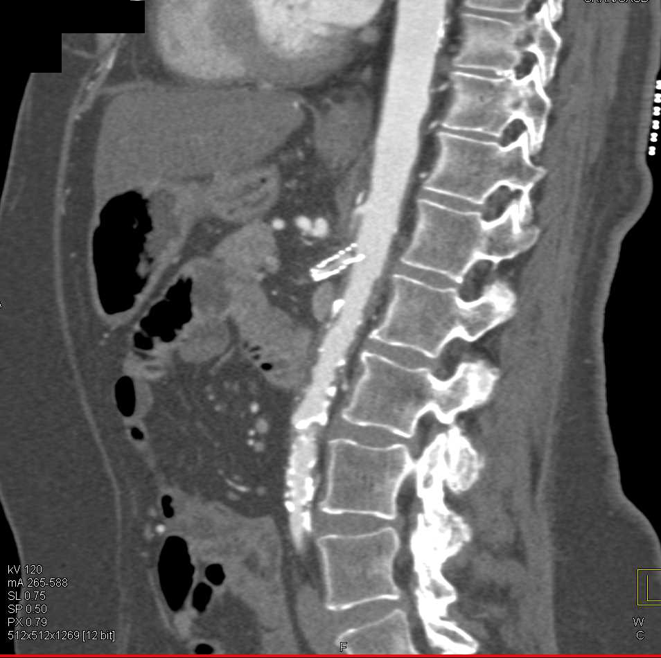 Celiac Stenosis and Stent in the SMA - CTisus CT Scan