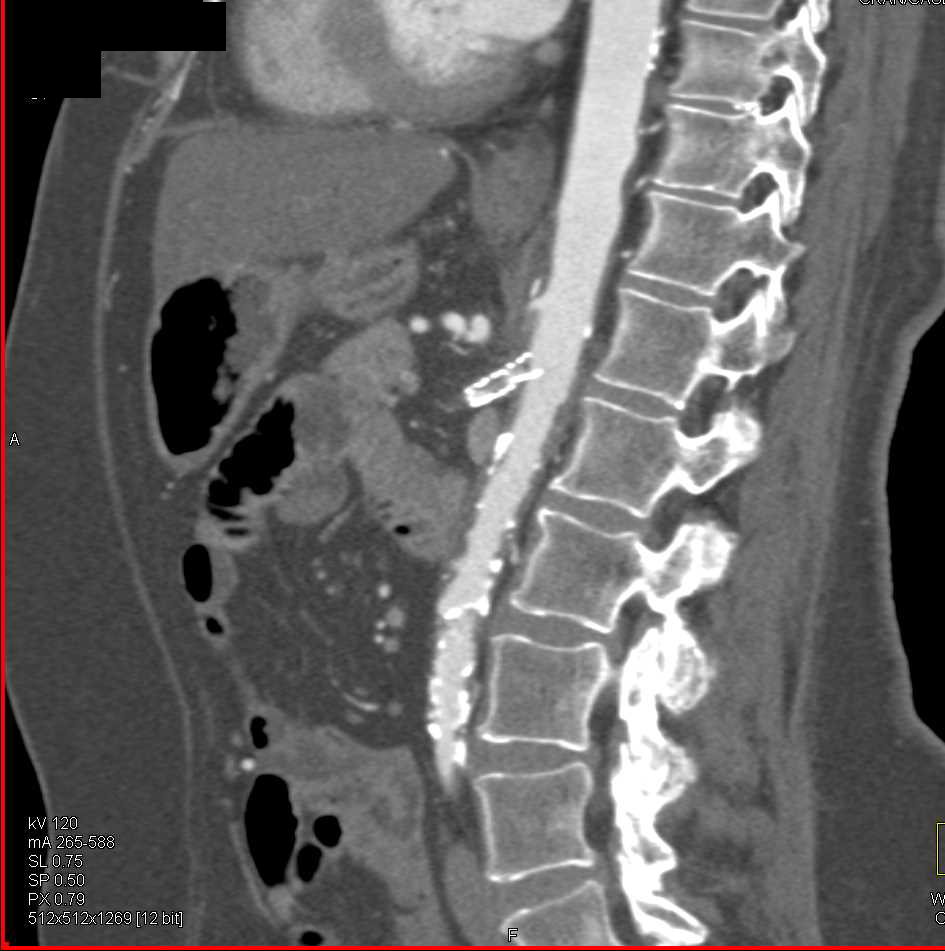 Carotid Artery Disease and Mesenteric Vessel Disease - CTisus CT Scan