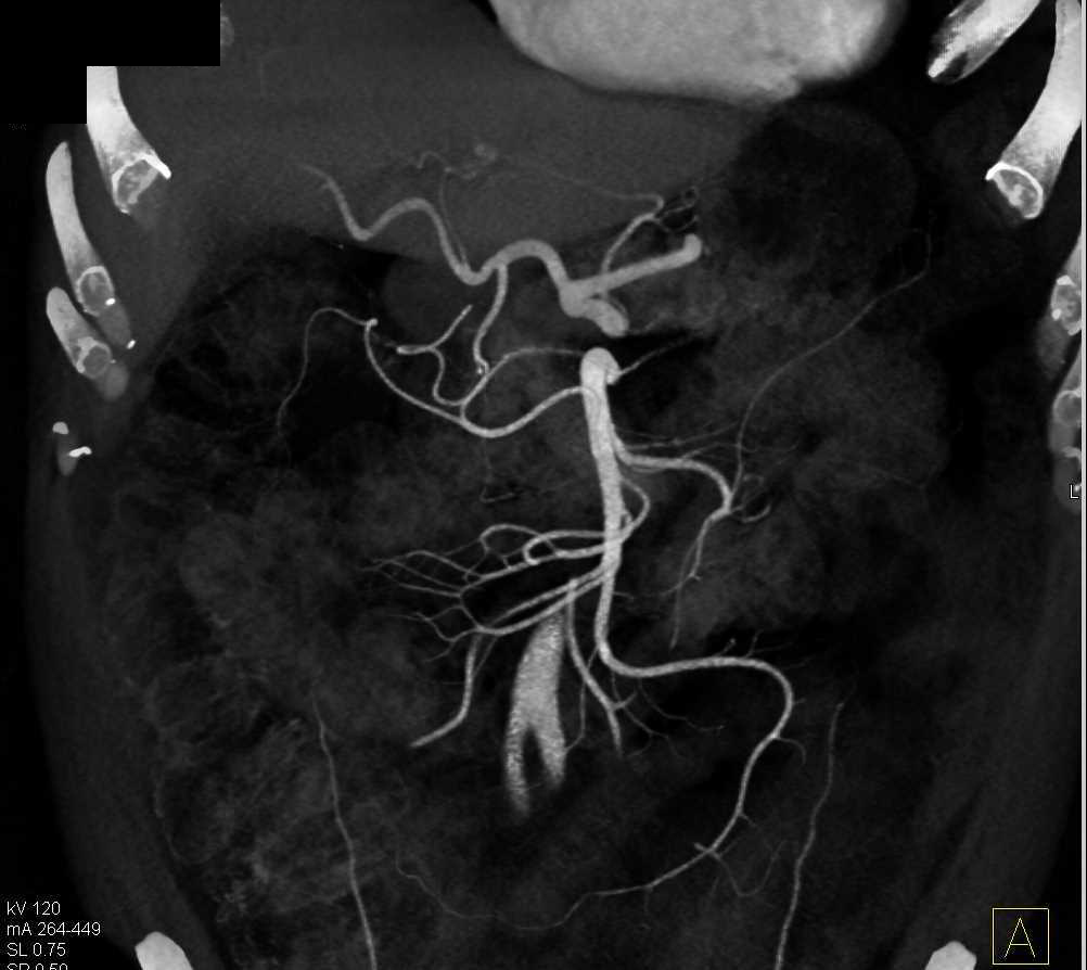 Mesenteric Vascular Mapping - CTisus CT Scan