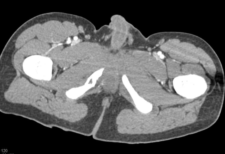 Fracture of the Right Superior and Inferior Pubic Ramus with Negative Angiogram - CTisus CT Scan