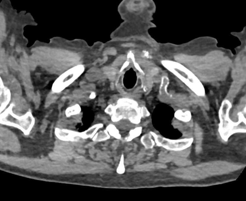Extensive Vascular Calcifications in the Aorta - CTisus CT Scan