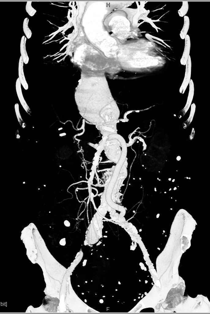 Abdominal Aortic Aneurysm with Vascular Bypass to Mesenteric Vessels - CTisus CT Scan