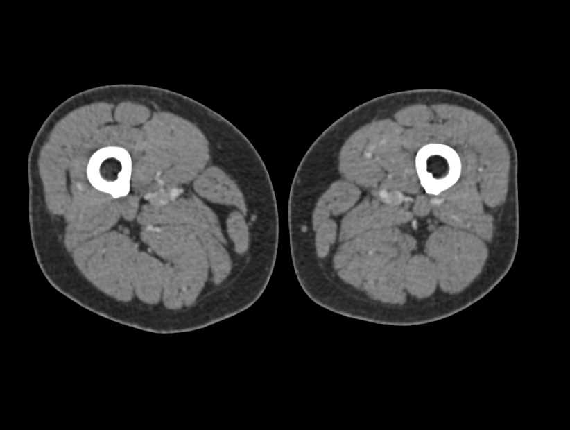 Deep Vein Thrombosis (DVT) in the Left Popliteal Vein - CTisus CT Scan