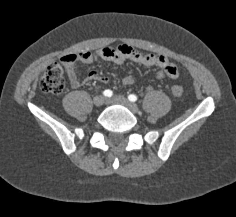 CTA Without Vascular Compromise - CTisus CT Scan