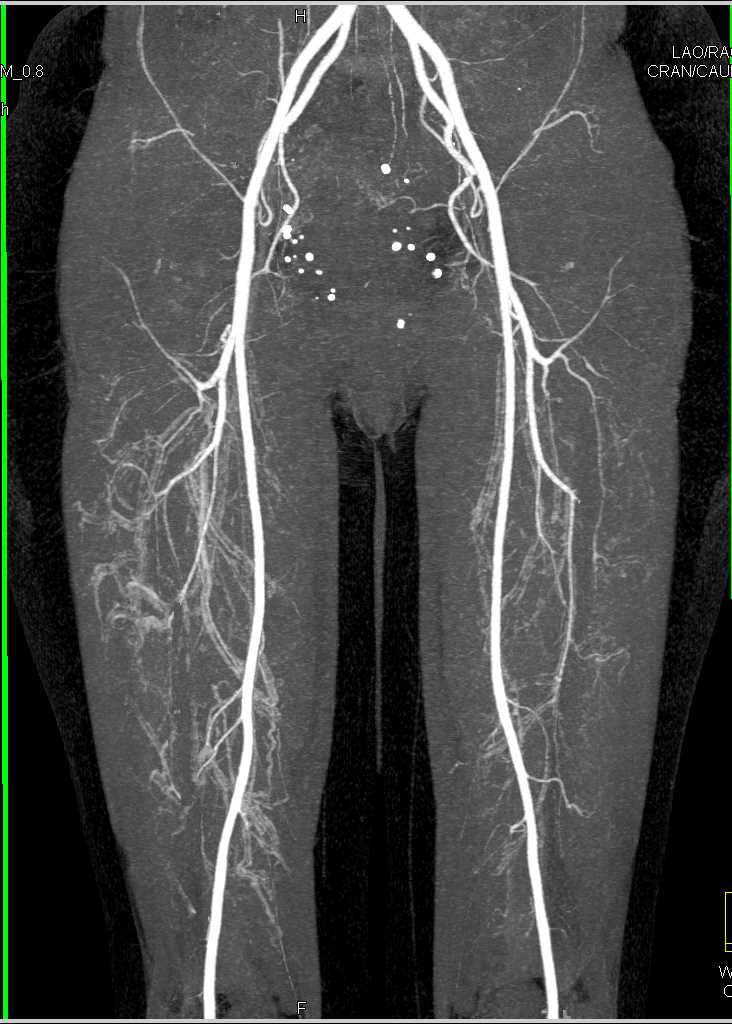 CTA Without Vascular Compromise in the Arterial System - CTisus CT Scan