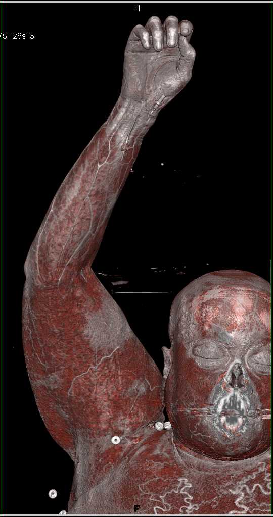 Vascular Calcification in the Radial and Ulnar Arteries - CTisus CT Scan