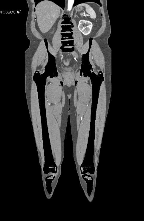 CTA with Occlusion Right Superficial Femoral Artery (SFA) and Popliteal Artery on Dual Energy CT Scan - CTisus CT Scan