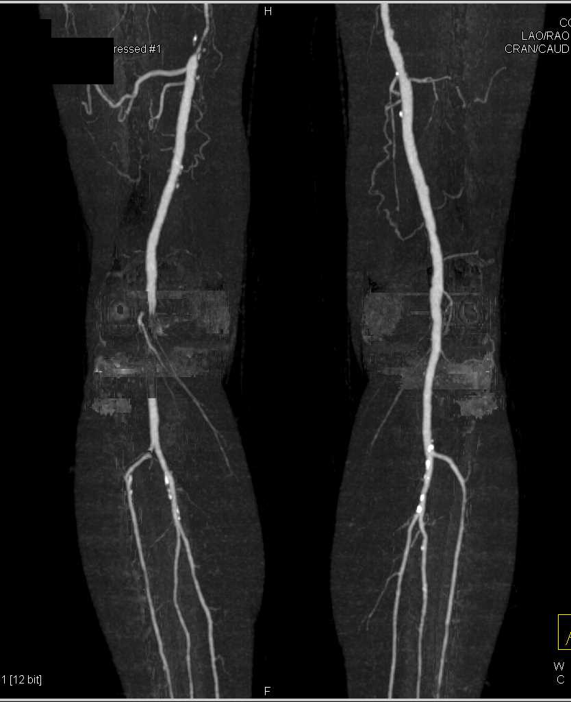 CTA with Occlusion Right Superficial Femoral Artery (SFA) and Popliteal ...