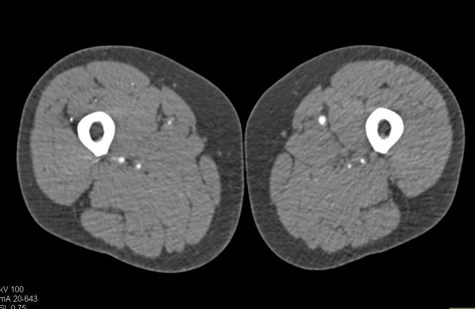 CTA with Occlusion Right Superficial Femoral Artery (SFA) and Popliteal Artery on Dual Energy CT Scan - CTisus CT Scan