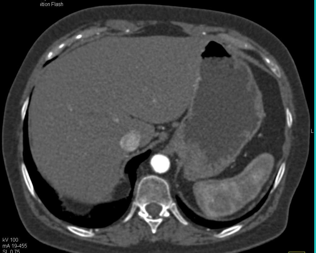 Aortic Occlusion due to Atherosclerotic Disease with Collaterals - CTisus CT Scan